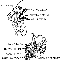 Figura 1: Nervio crural (Esquema Dra. Miriam Assuero)
