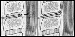 Figura 1: Dibujo esquemático de la rotación en 180º del bisel de la aguja epidural. En el panel izquierdo se ve la deflexión de la aguja espinal y, con una línea punteada, el eje mayor de la aguja epidural. En el panel derecho se observa la dirección adoptada por el catéter epidural.