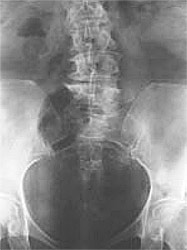 radiografía de la articulación sacroilíaca normal